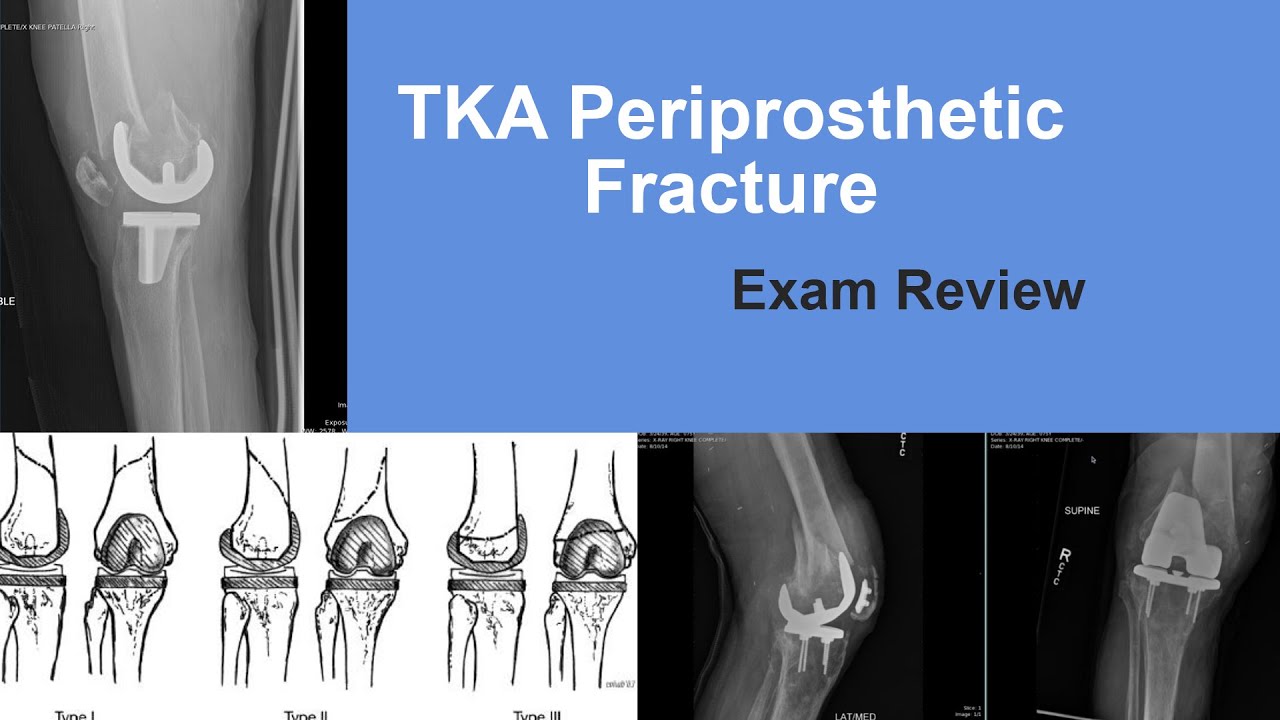 TKA Periprosthetic Fracture Exam Review - Matt Austin, MD