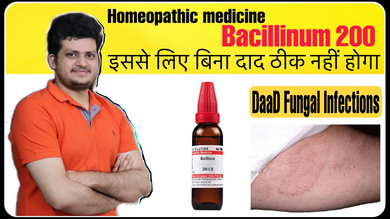 Best Homeopathic Medicine for Fungal Infection Ringworm or tinea corporis | Bacillinum 200 |