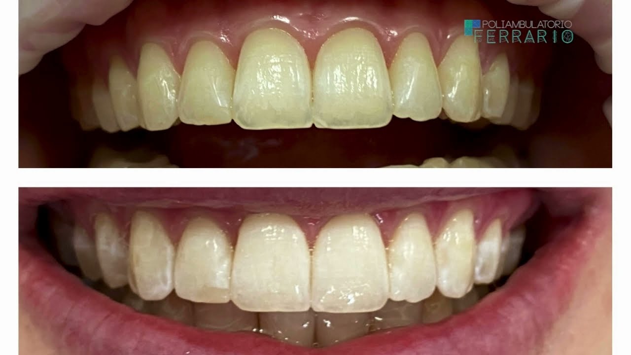Sbiancamento dentale di ultima generazione