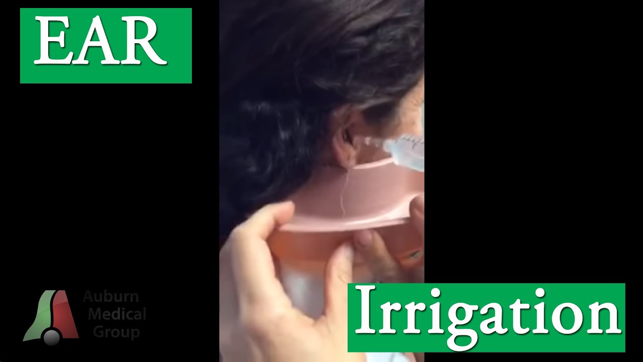 Ear Irrigation for Cerumen (Ear Wax) Removal | Auburn Medical Group