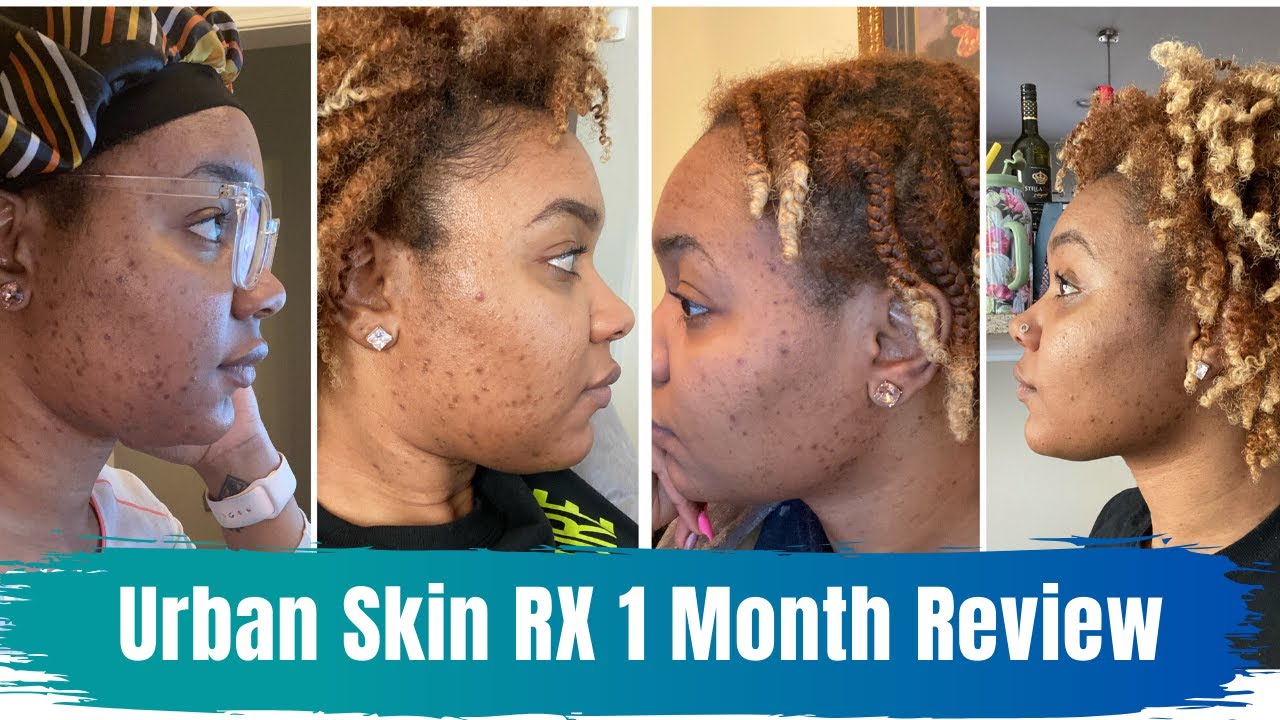 Urban Skin RX 1 Month Review | Get rid of Hyperpigmentation | Dark Spots | Combo Skin