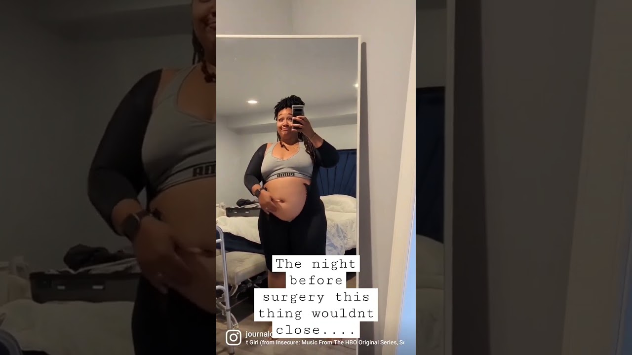 From pre-op to 3 weeks posts-op plus-size mommy makeover