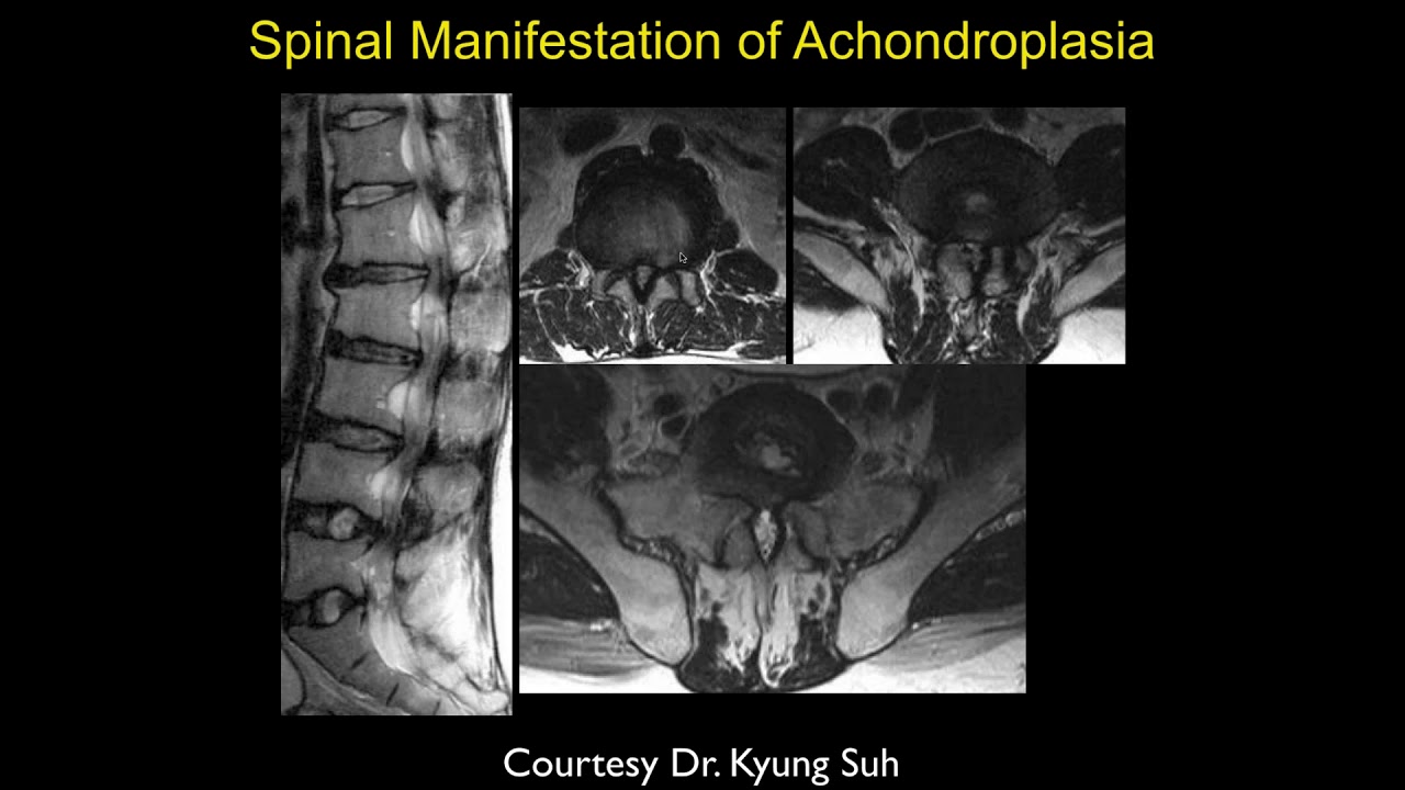 Lumbar Congenital Pt  2