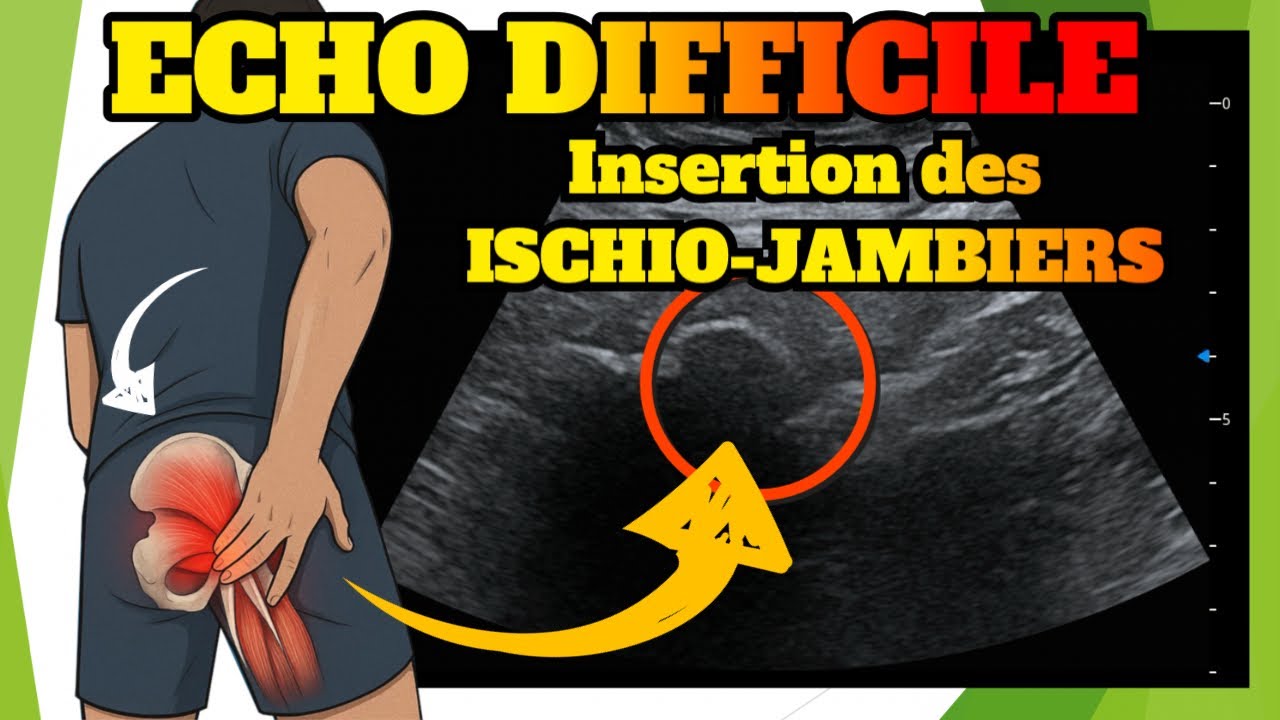 Echographie des ischio jambiers: lésion du tendon proximal