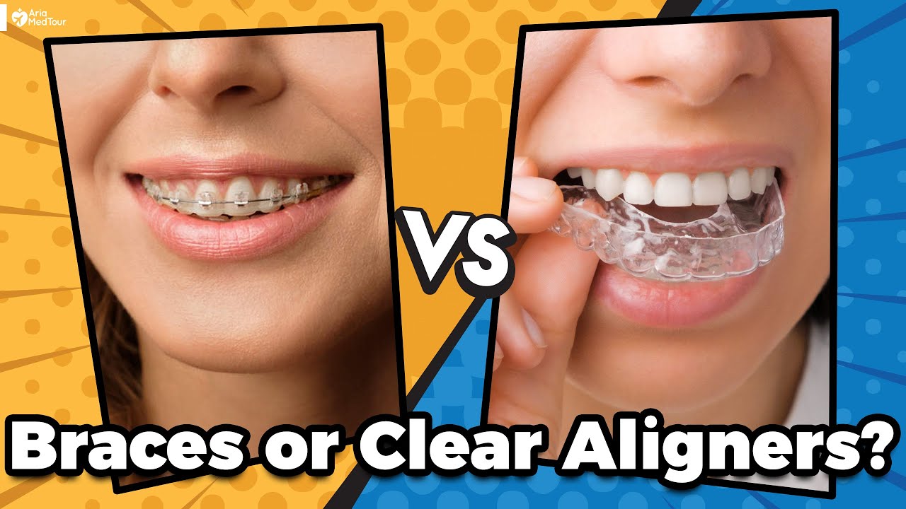 Braces vs Invisalign : Which Orthodontic Treatment Is Best For You