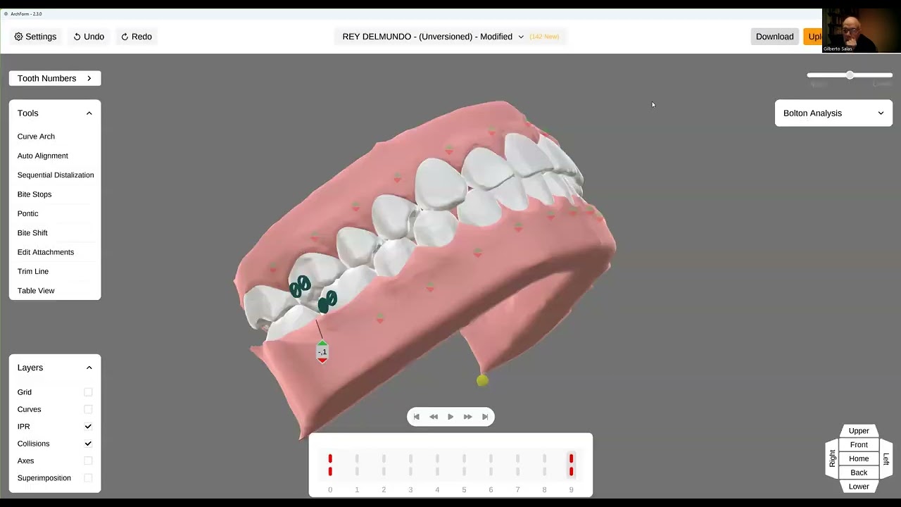 ArchForm un software muy completo para movimientos de ortodoncia