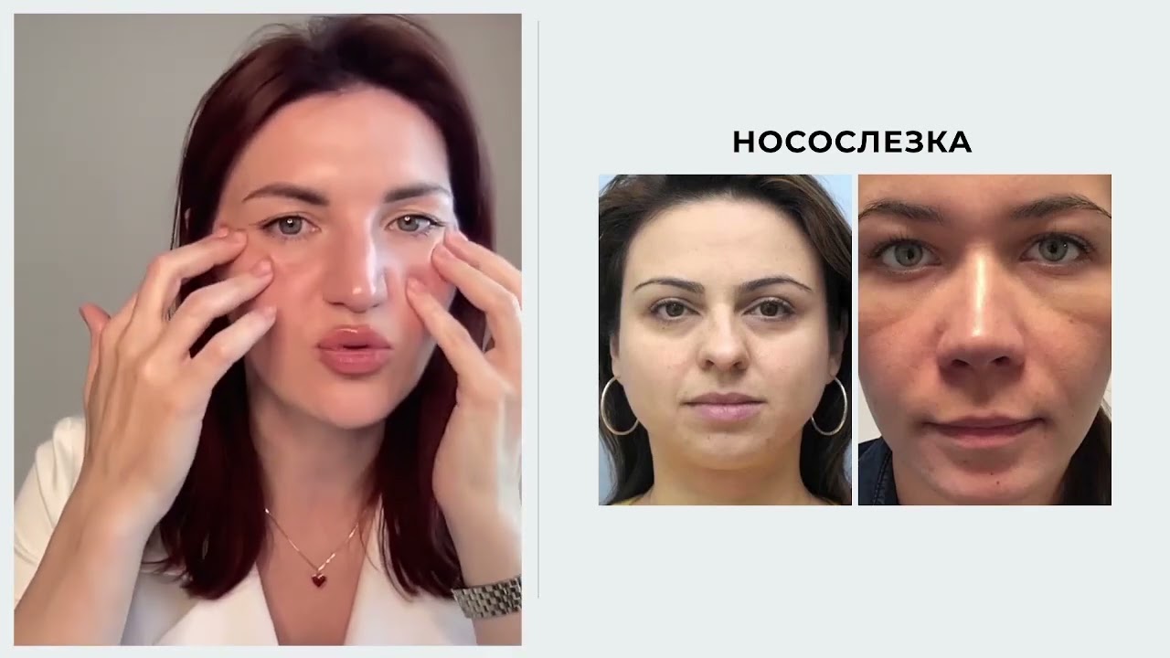 ⚠️ Как убрать носослёзную борозду массажем?