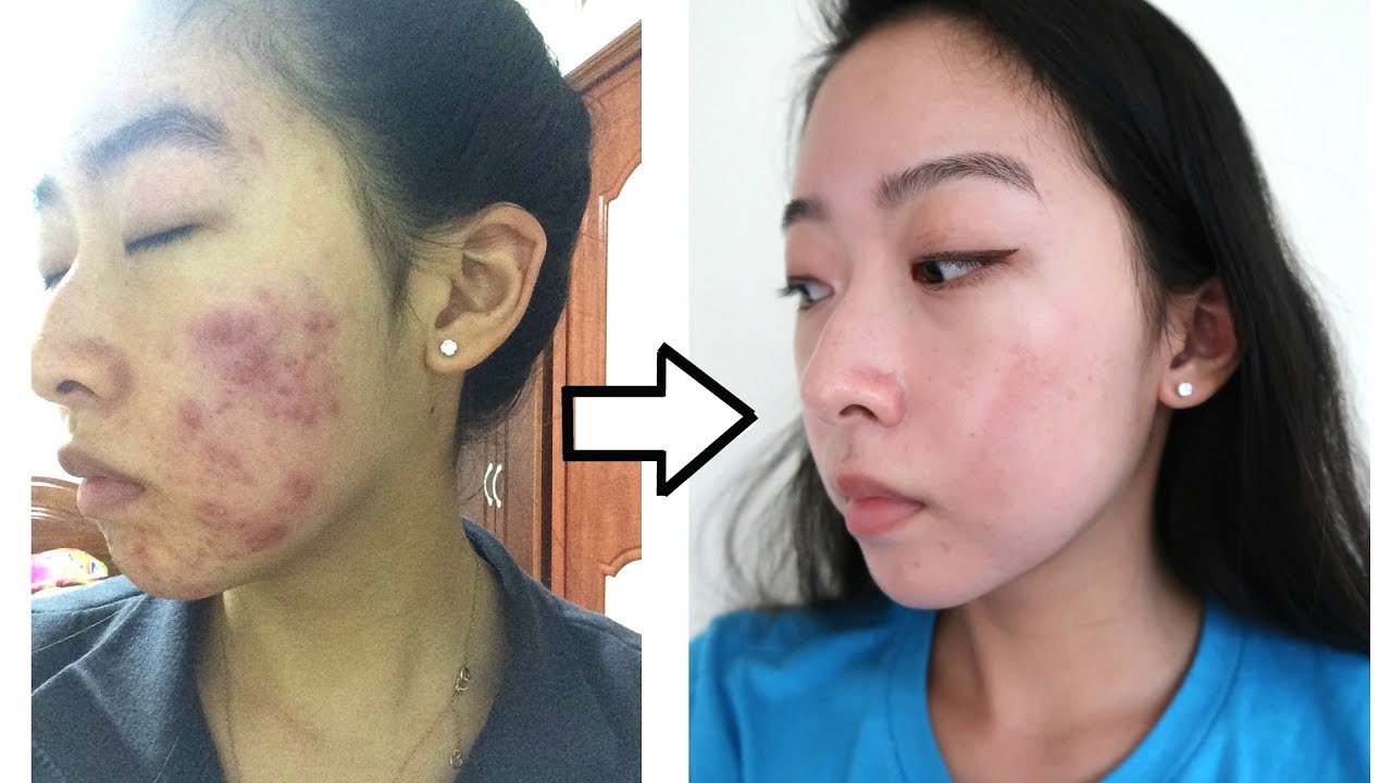 How I Cleared My Acne with ONE Product (NO ACCUTANE)