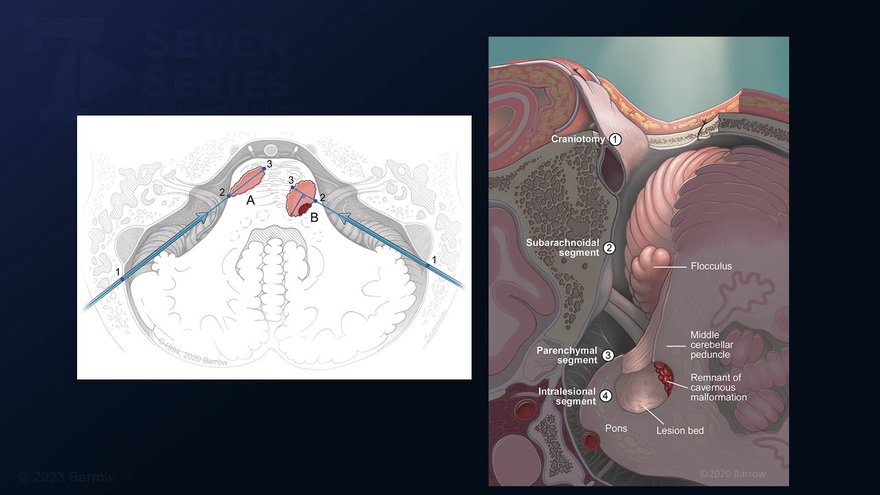Telovelar Approach for Resection of an Inferior Peduncular Pontine Cavernous Malformation