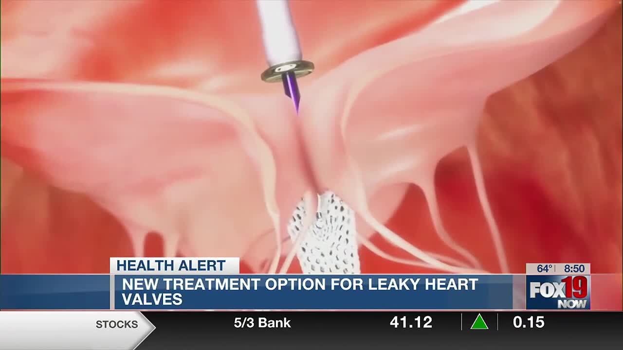 New treatment option for leaky heart valves