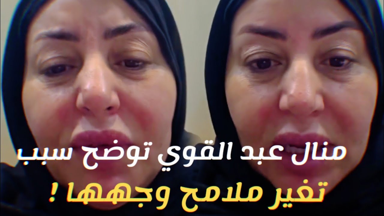 منال عبد القوي توضح سبب تغير ملامح وجهها !