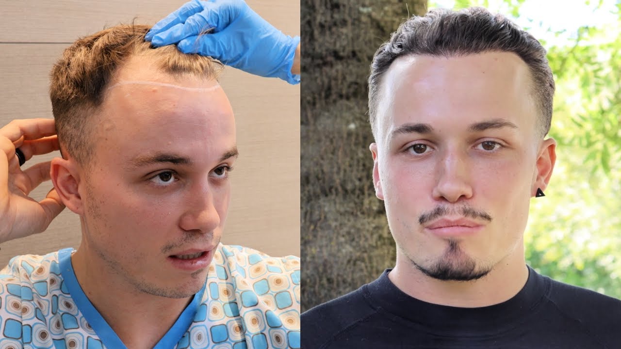 8 Monate nach Haartransplantation: Basti’s krasses Update | Geheimratsecken