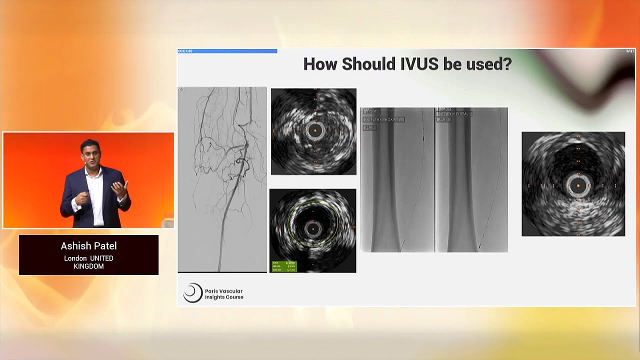 The value of IVUS in PAD procedures: a game changer - PVI 2025