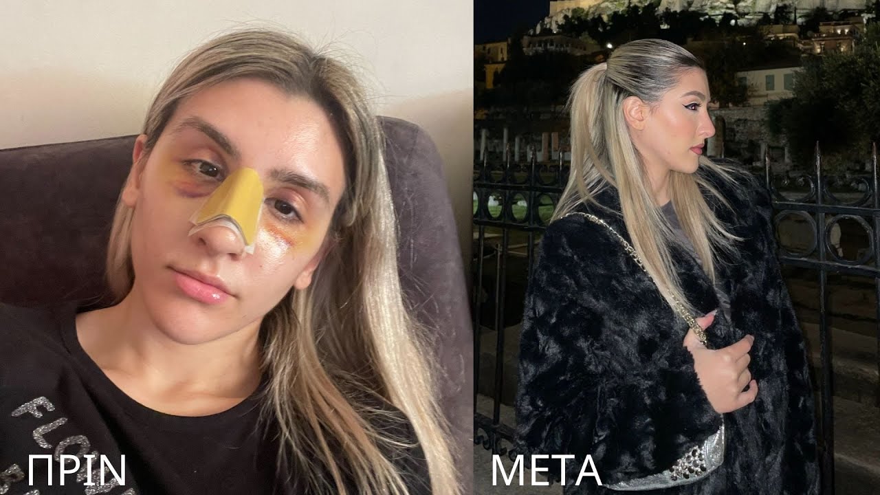 ΕΚΑΝΑ ΠΛΑΣΤΙΚΗ ΣΤΗΝ ΜΥΤΗ | οτι πρέπει να ξέρεις