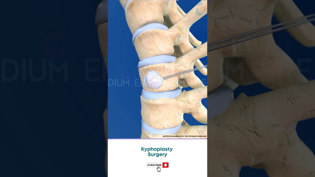 Spine Fracture Kyphoplasty ↪ 3D Medical Animation #Shorts #Kyphoplasty #KyphoplastySurgery #Spine
