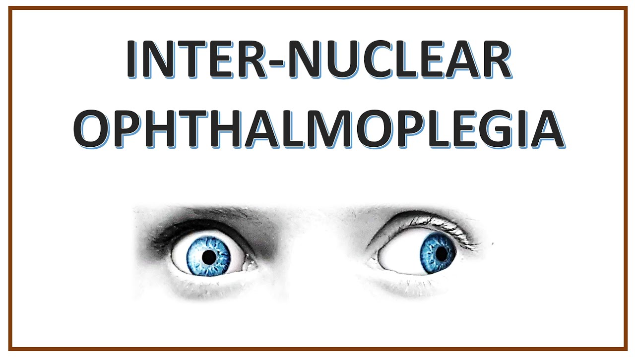 Internuclear Ophthalmoplegia | INO | WEBINO Syndrome | One and Half Syndrome