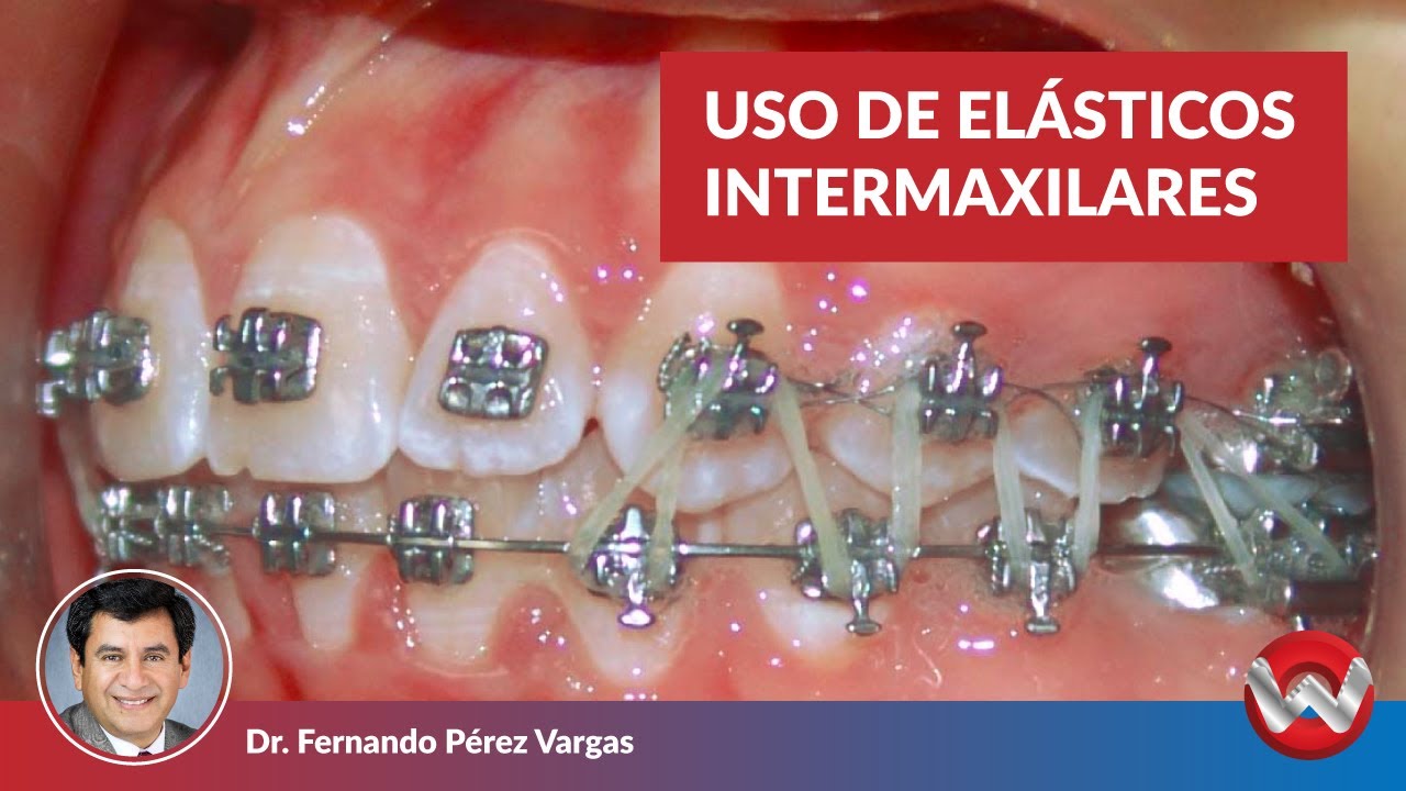 Uso de Elásticos Intermaxilares