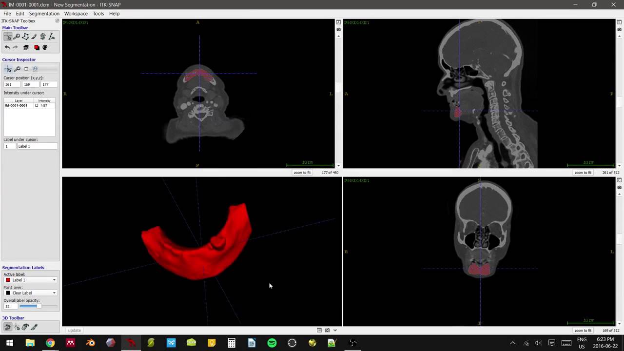 Patient CT Mandible Segmentation for 3D Print Tutorial [ITK-SNAP, Meshmixer, Makerbot]