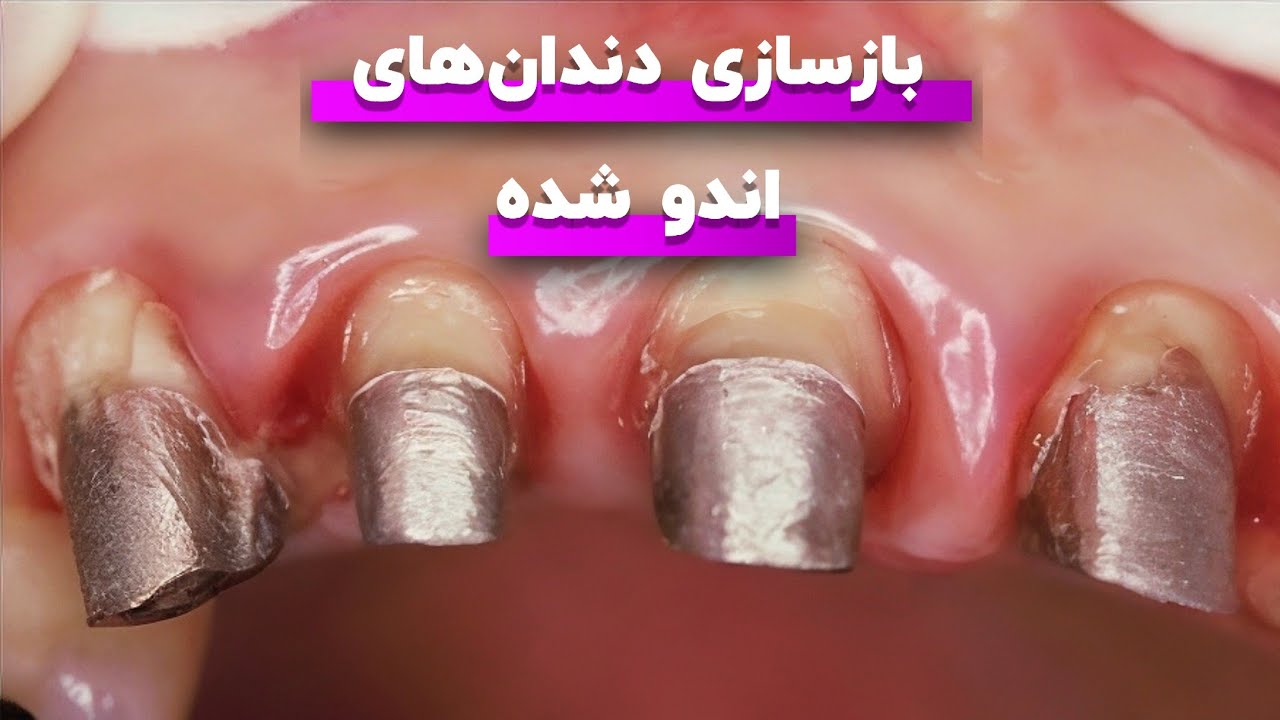 بازسازی دندان&zwnj;های اندو شده