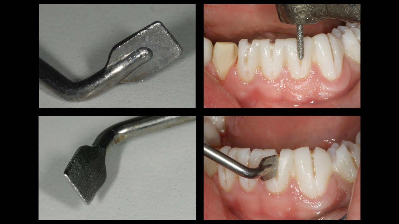 Provisional Veneers- Which Cement Do You Use?