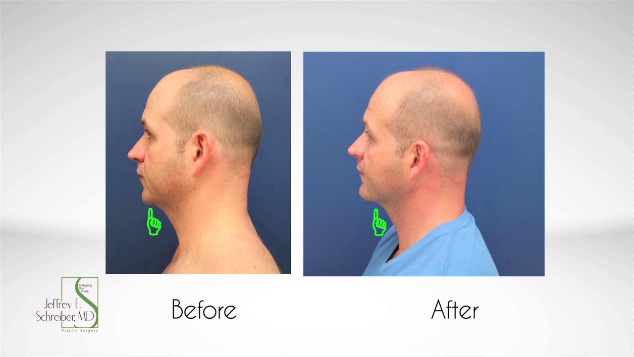 Baltimore Chin Implant Video by Plastic Surgery Expert, Dr. Jeffrey Schreiber