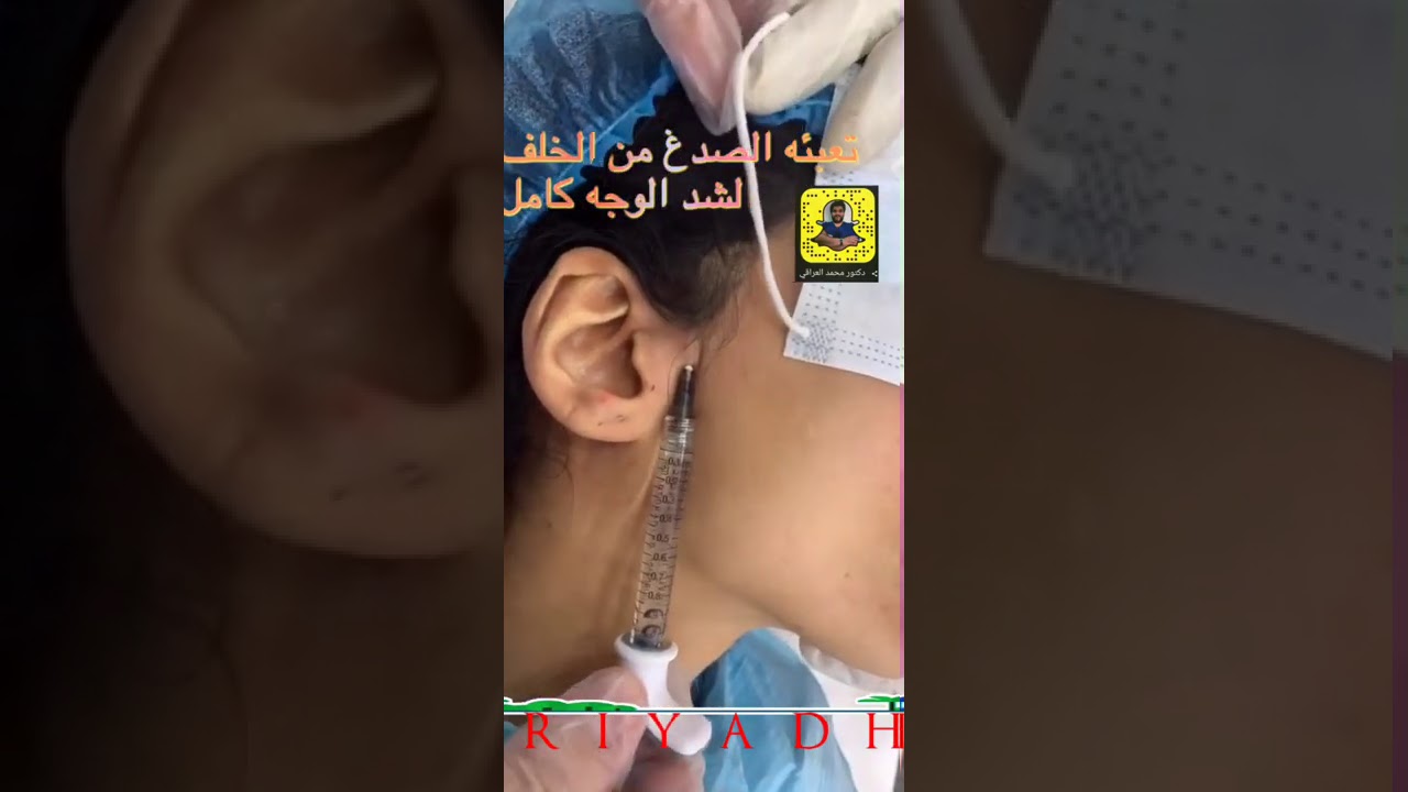 فيلر شد الوجه كامل من خلال الحقن تحت فروه الراس
