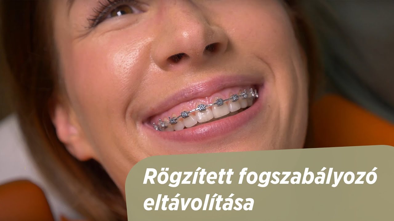Fogszabályozó készülék eltávolításának lépései - Optimum Fogászat