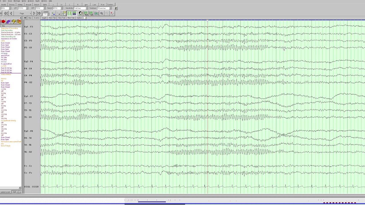 The Normal Adult EEG
