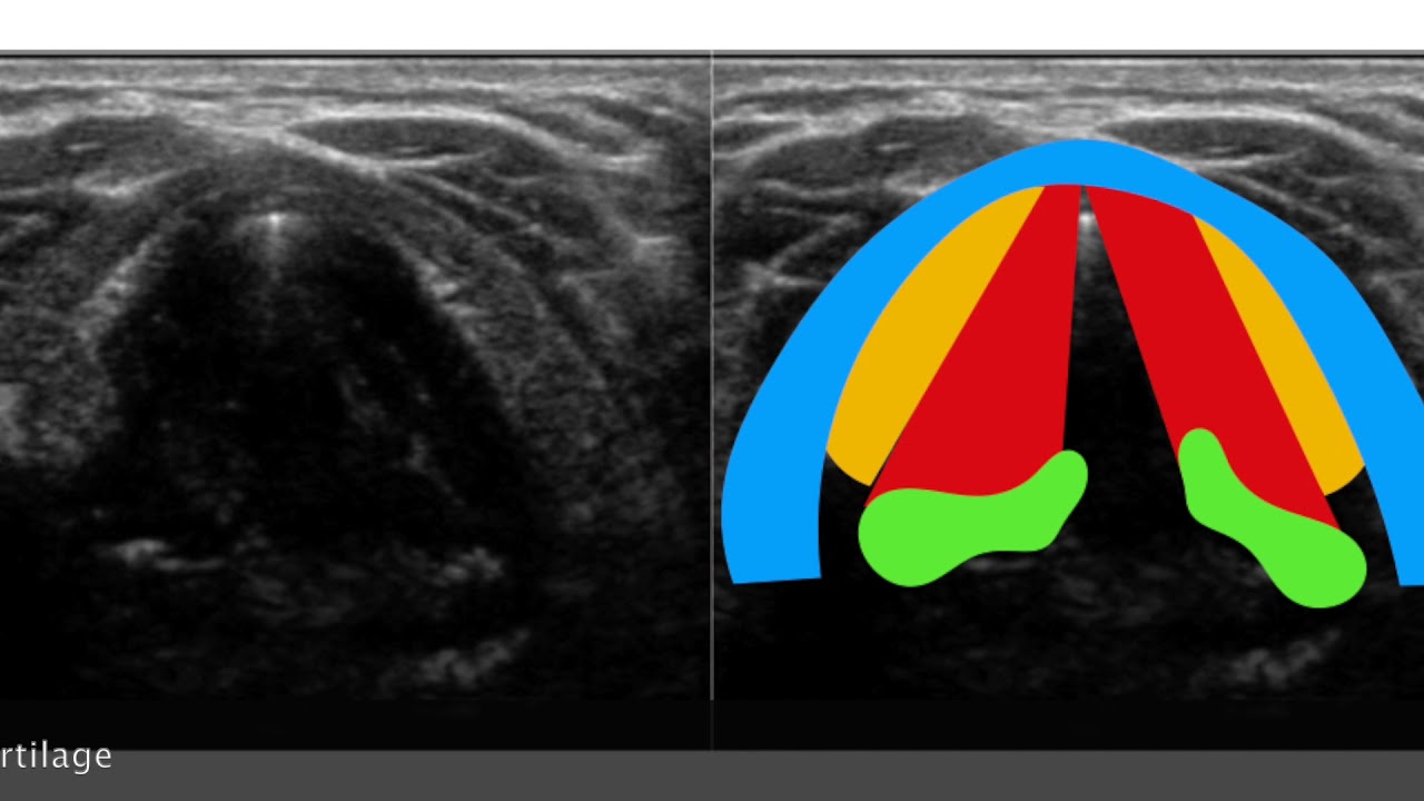 Neck  Larynx: Vocal cord paralysis