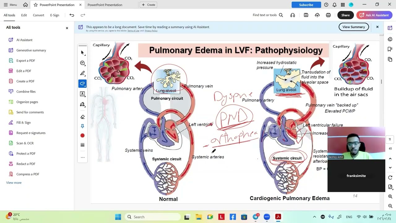 Heart Failure | Right vs Left side failure part 1 of 2