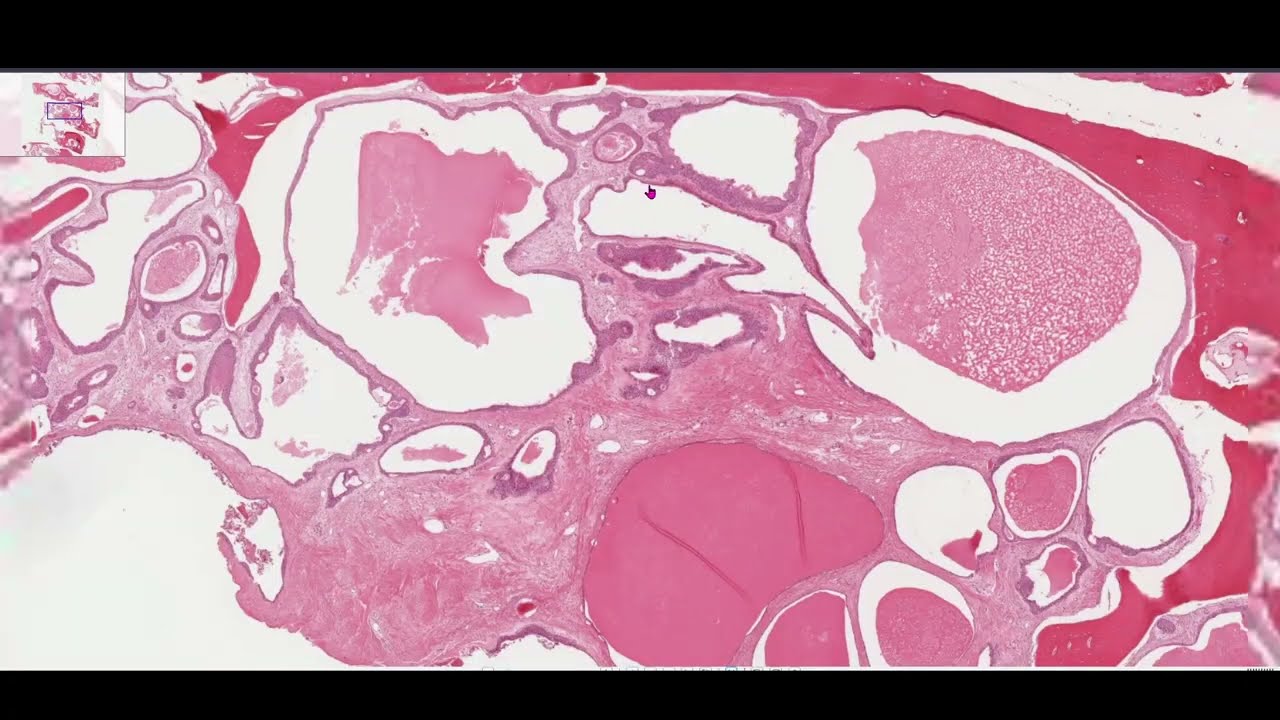 Glandular Odontogeniic Cyst