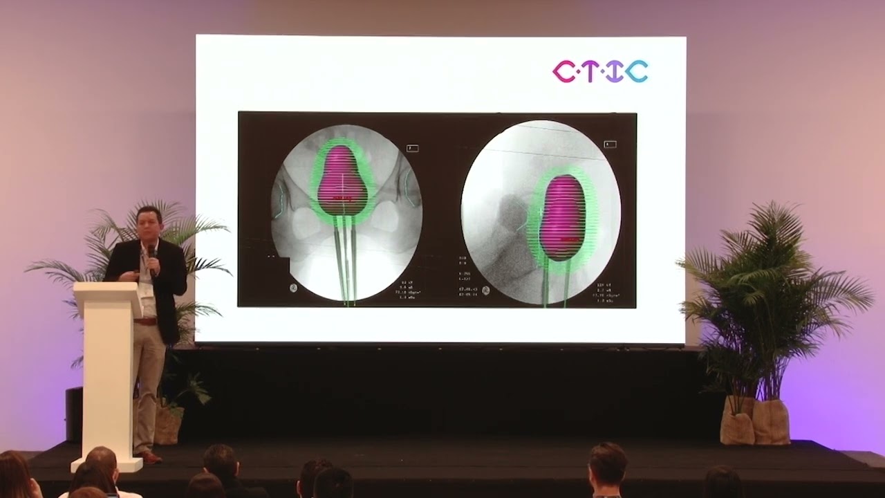 ¿Que podemos decir sobre la braquiterapia intracavitaria ?