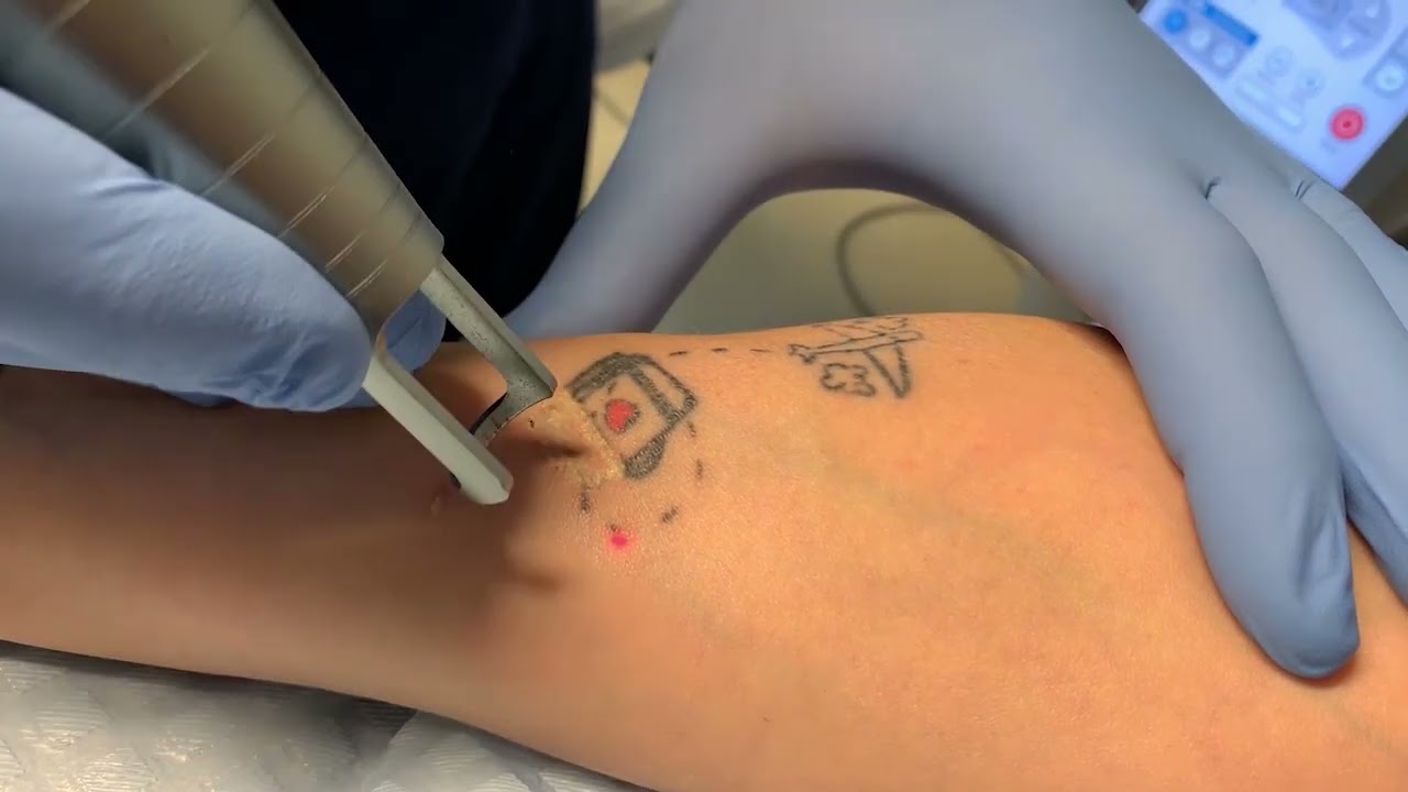 Trattamento Rimozione Tattoo Laser Q Switched