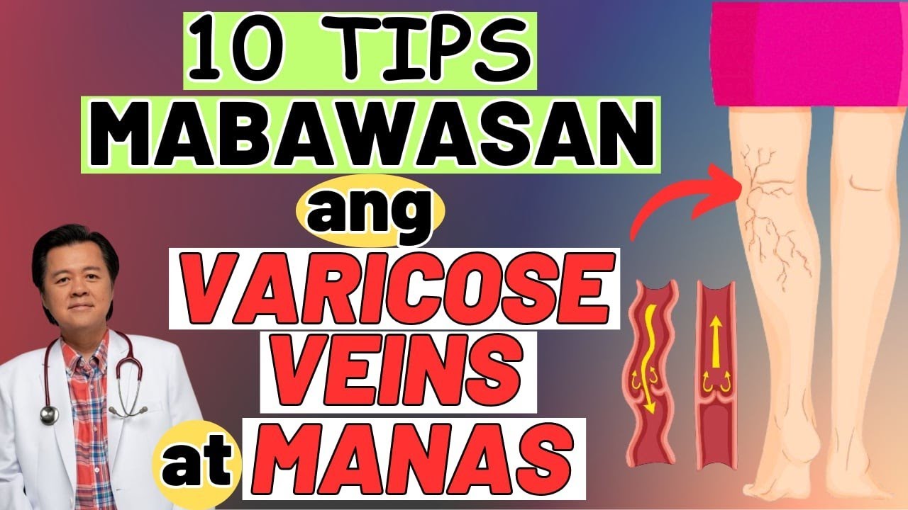 10 Tips Mabawasan ang Varicose Veins at Manas. - By Doc Willie Ong (Internist and Cardiologist)