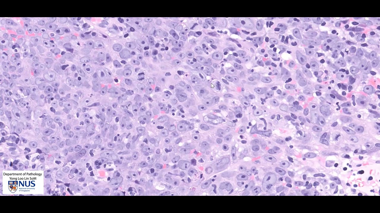 Nasopharyngeal carcinoma microscopy - Talking slide