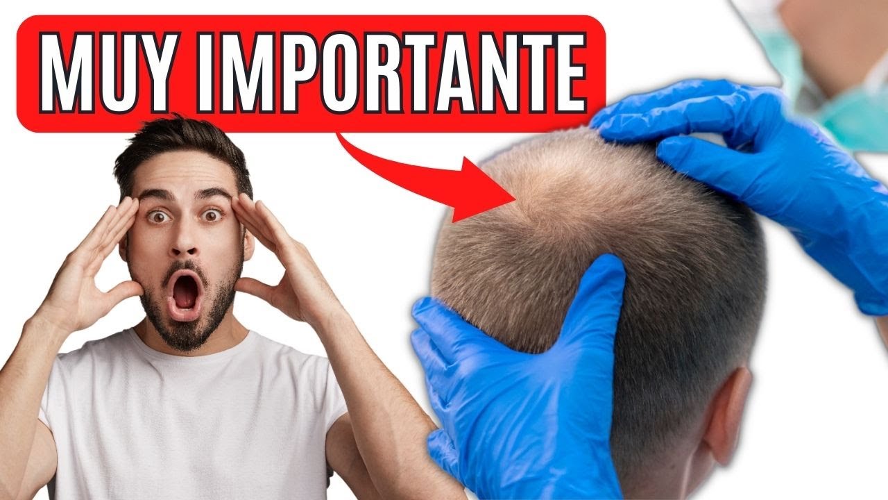 Injerto Capilar en la CORONILLA ⚠ ¿Por qué tarda tanto en crecer?
