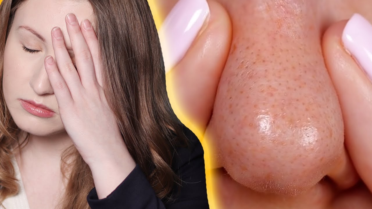 Kosmetolog reaguje na 5 minute crafts. Sposoby na zaskórniki