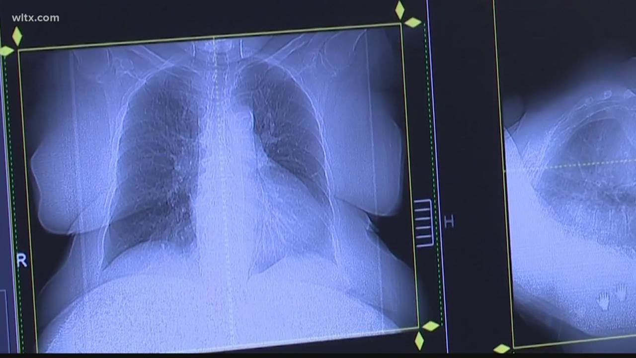 Doctors warn lung damage from COVID-19 may be permanent