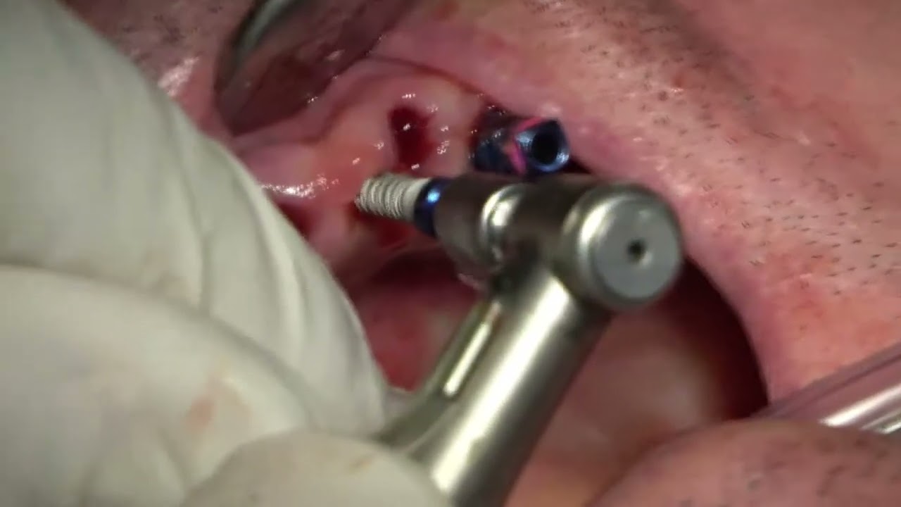 Implantologia Senza Osso evita innesti e rialzi Prof Conte