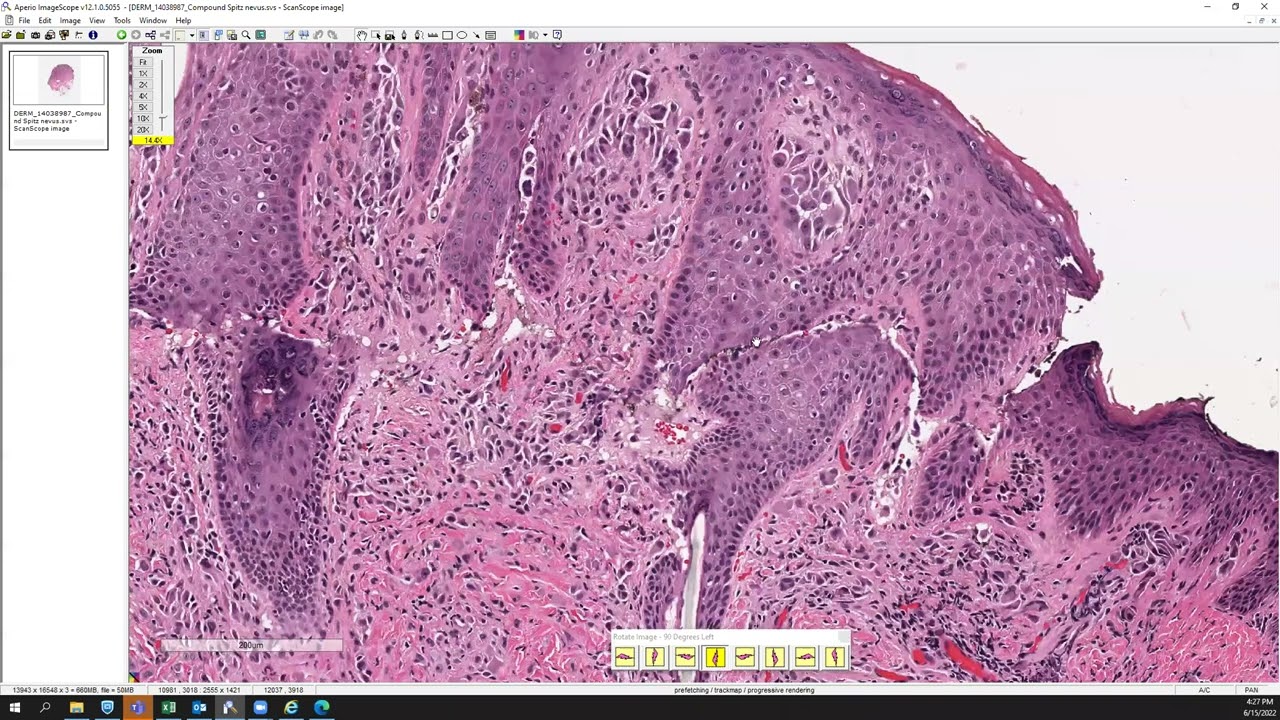 Compound Spitz nevus.