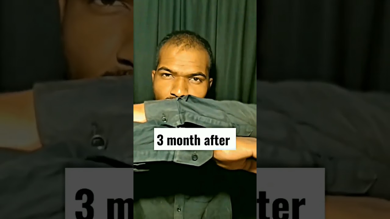 minoxidil or finasteride 3 month hair growth result @AvinashJadhavHairCare #shorts