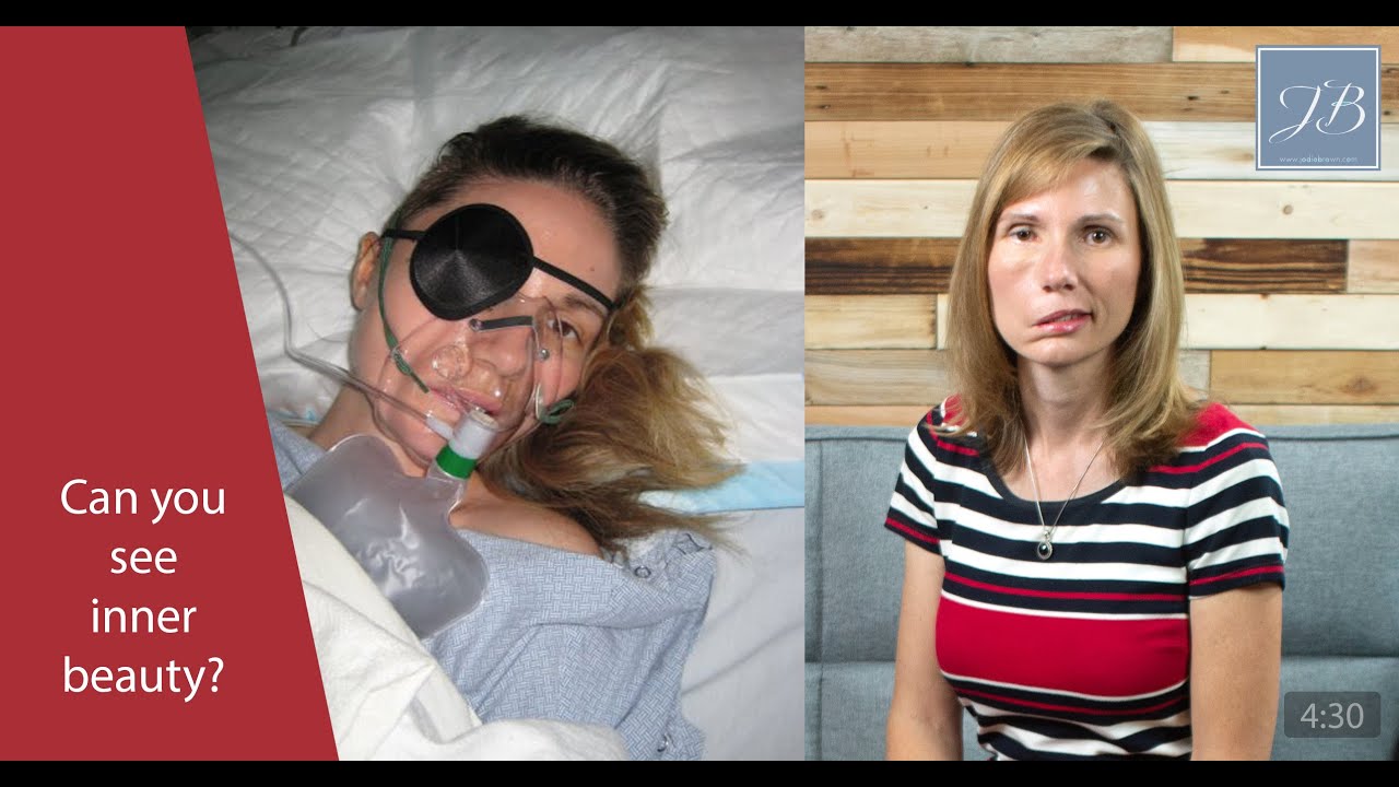 You are Beautiful: Brain tumor survivor discovers true identity, Jodi Orgill Brown, Facial Paralysis