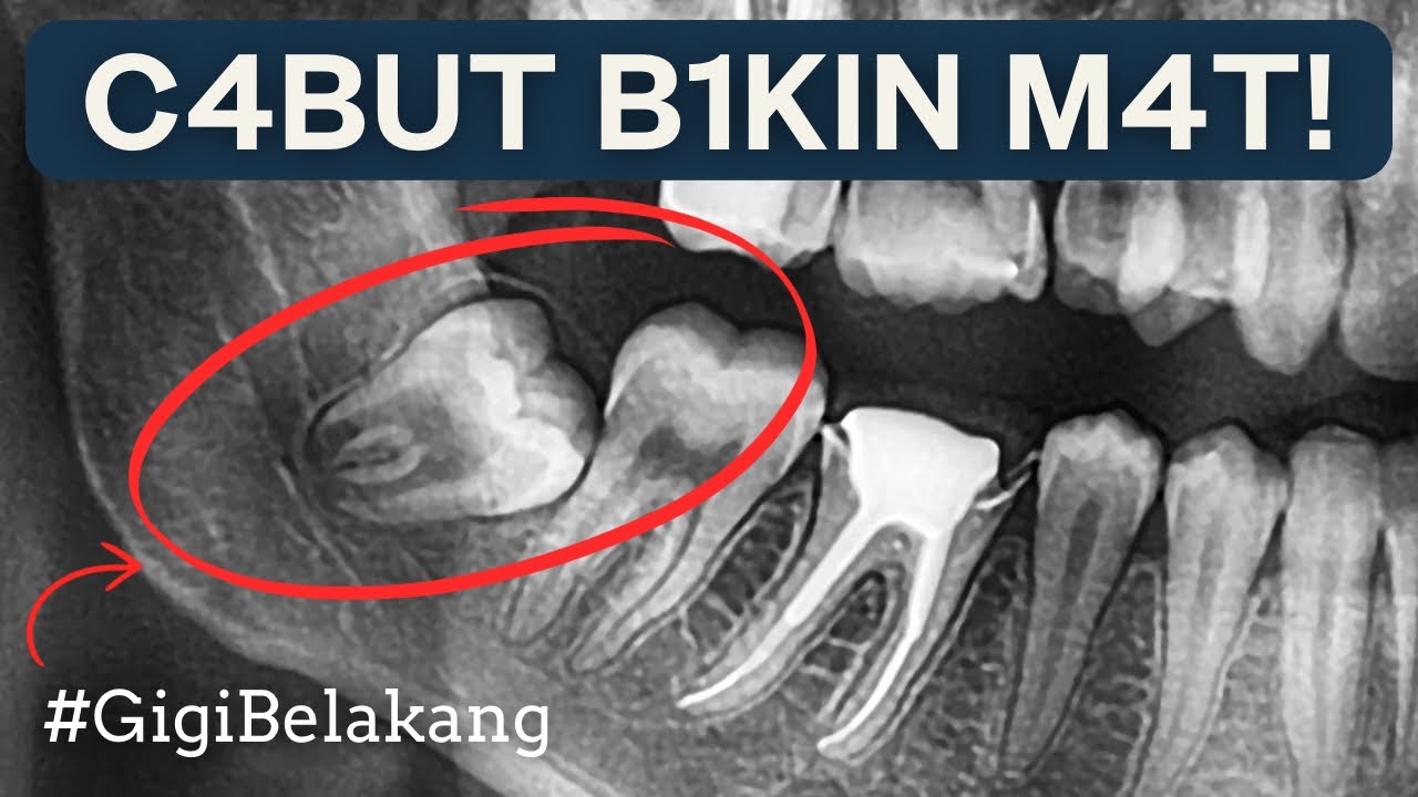 YANG MAU CABUT TONTON INI ⚠️ M3N1NG64L KARENA C4BUT GIGI BELAKANG ‼️