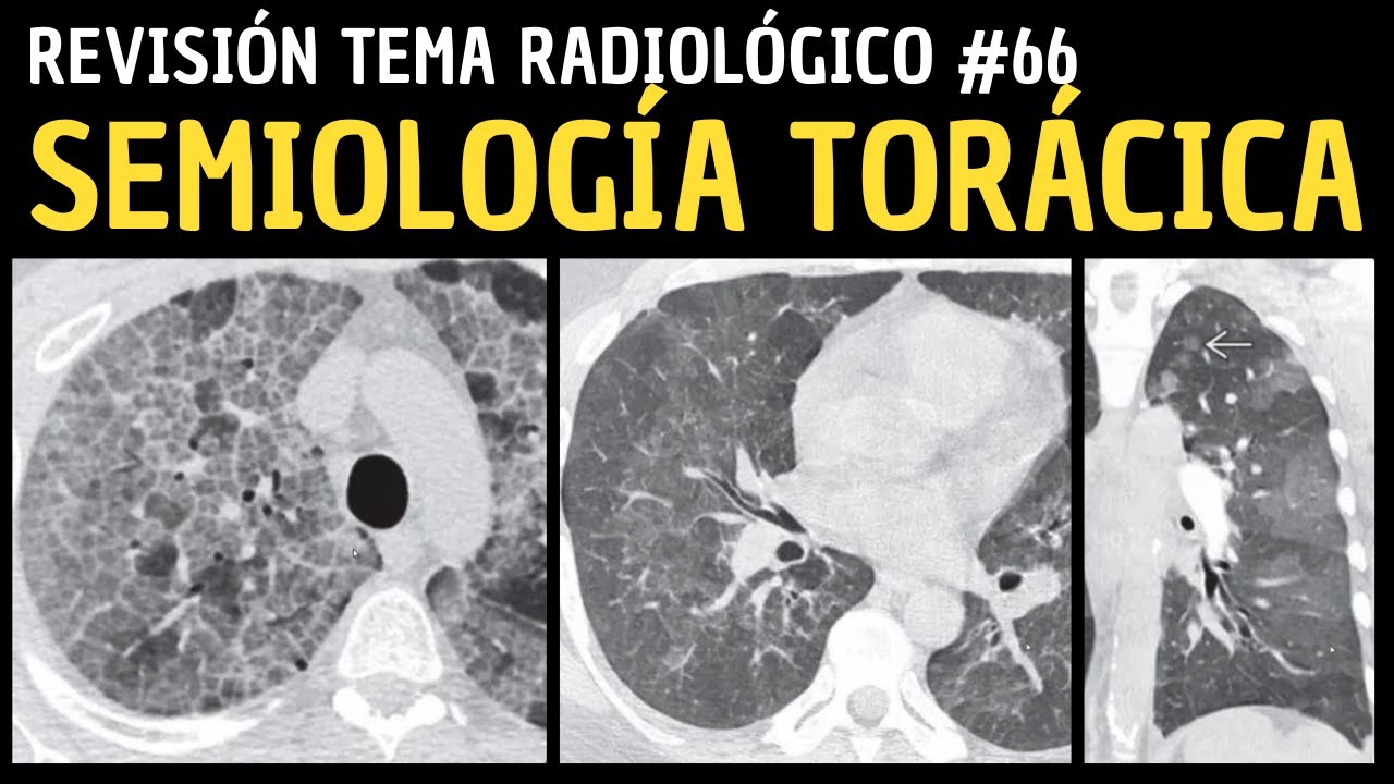 Revisión de Tema 66: Semiología torácica.