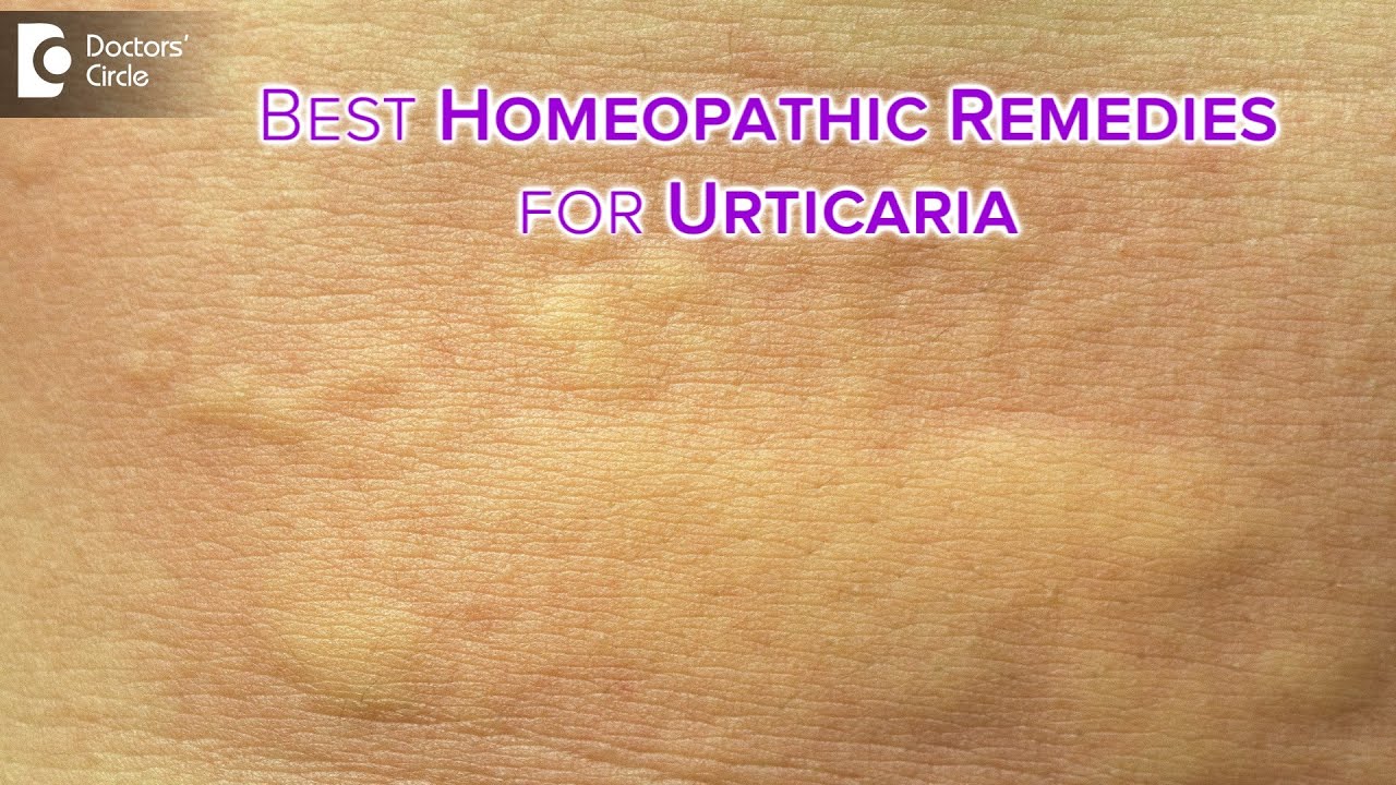 Detailed causes of  URTICARIA or HIVES |  Homeopathic Remedies -Dr.V.Bhagyalakshmi | Doctors' Circle