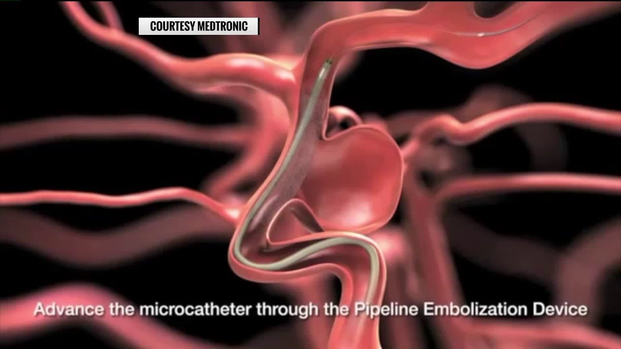A revolutionary non-surgical approach to treating aneurysms