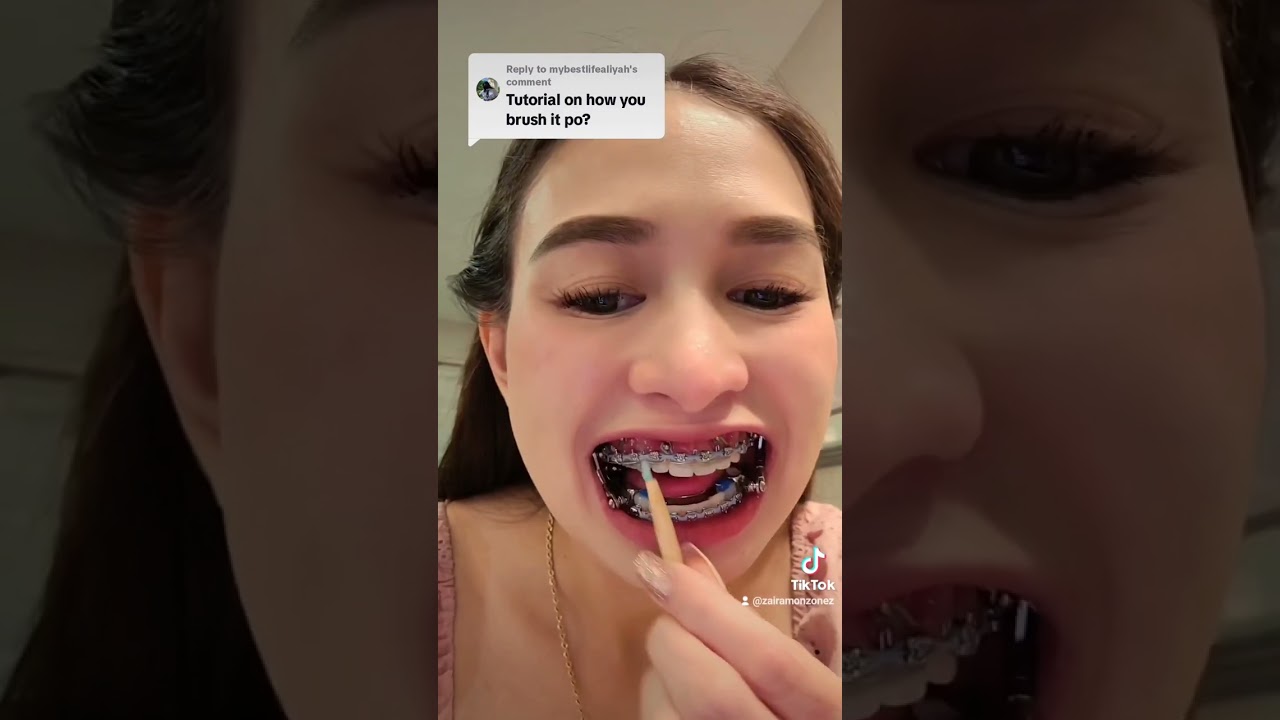 Tutorial on how I brush my Teeth ! Brace w/HERBST APPLIANCE
