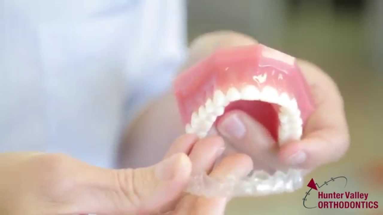 Orthodontic Treatment Options with Invisalign Clear Braces