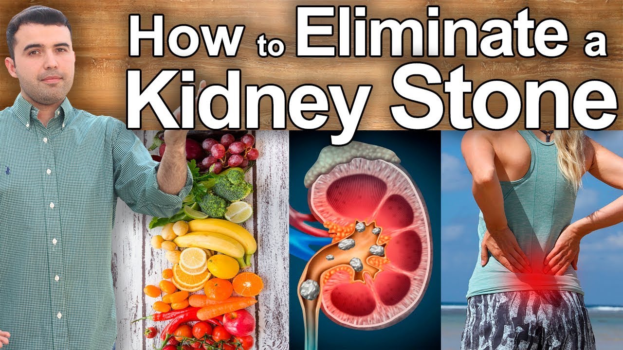 How to Eliminate Kidney Stones &ndash; Natural Treatments for Kidney Stones