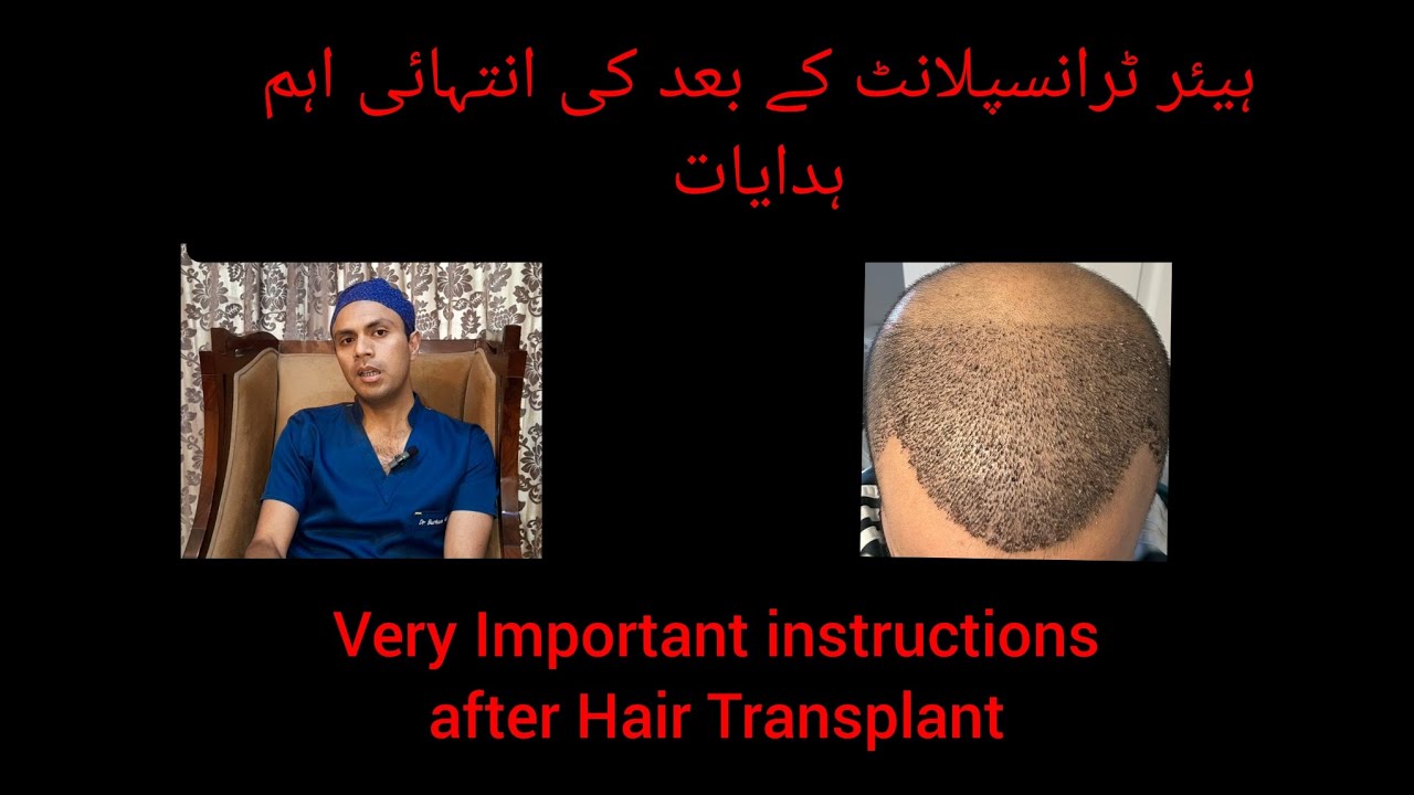 Must Listen Very Important Post Operative Instructions after Hair Transplant